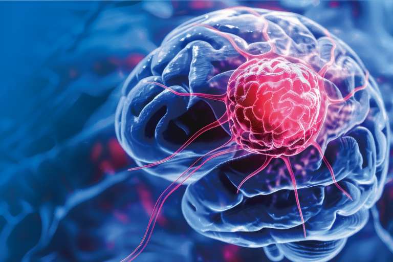 脳腫瘍遺伝子パネル検査